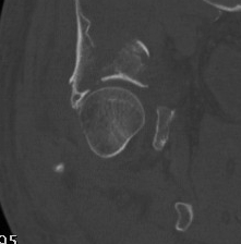 Acetabular Fractures CT Subchondral arc 1